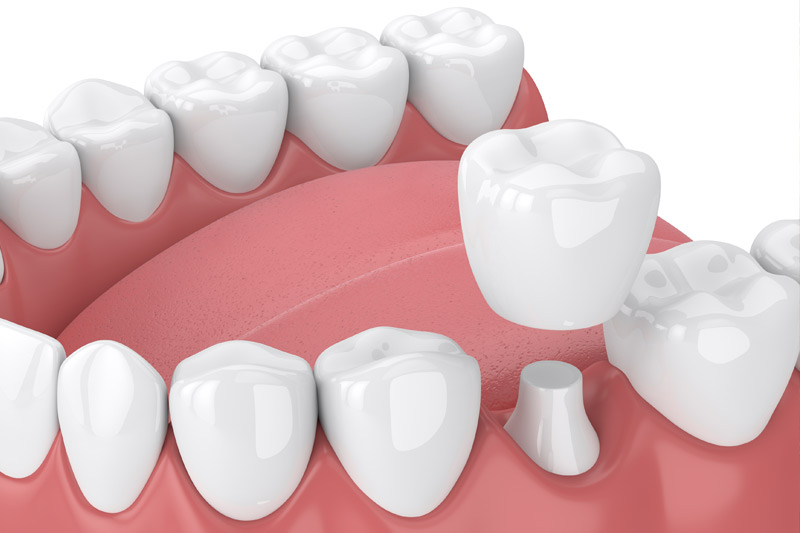 Dental Crowns in Kent
