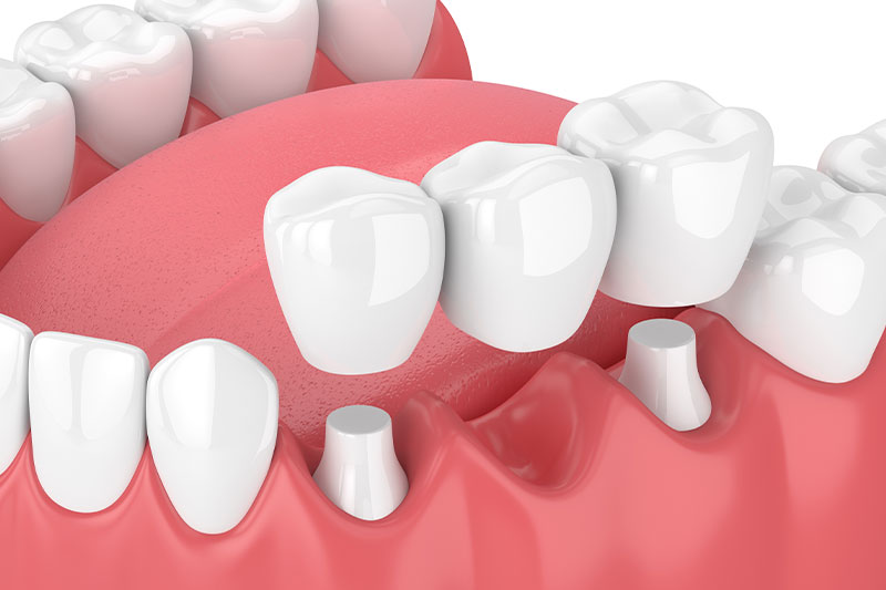 Dental Bridges in Kent