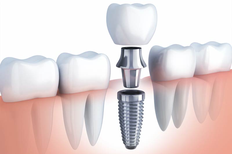 Dental Implants in Kent