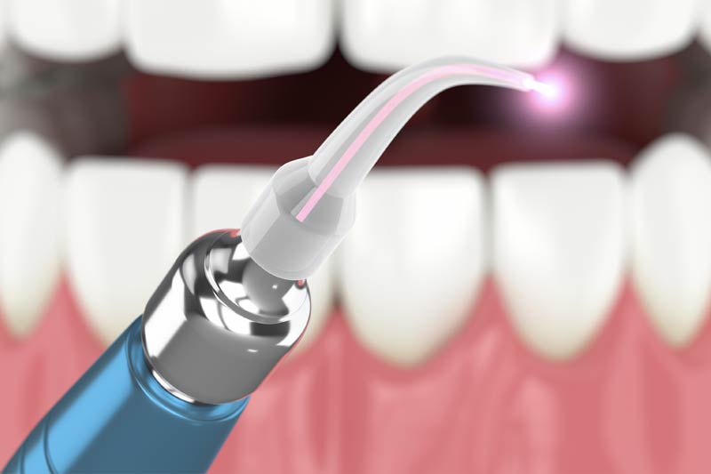 Laser Dentistry in Kent