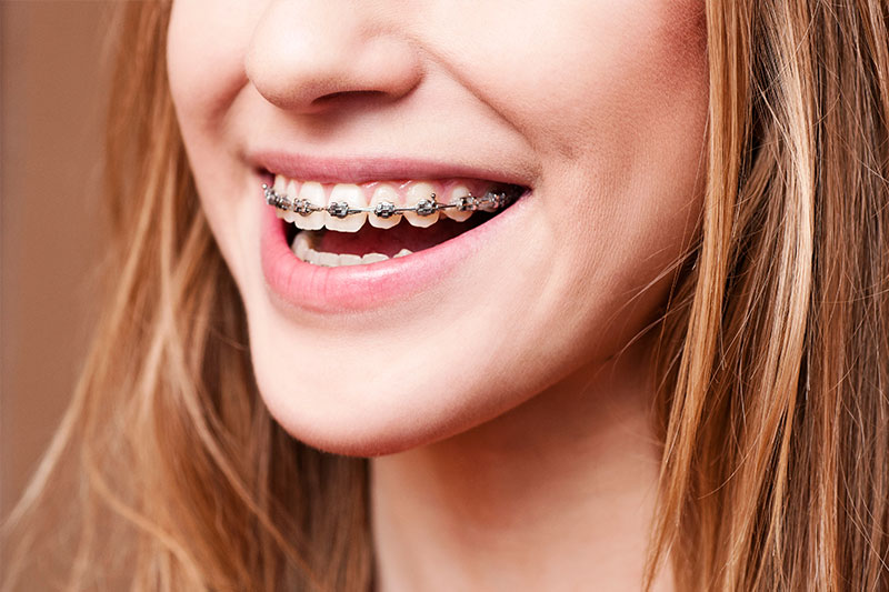 Orthodontics in Kent