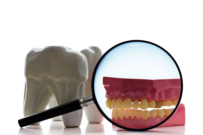 Root Canal Treatment in Kent