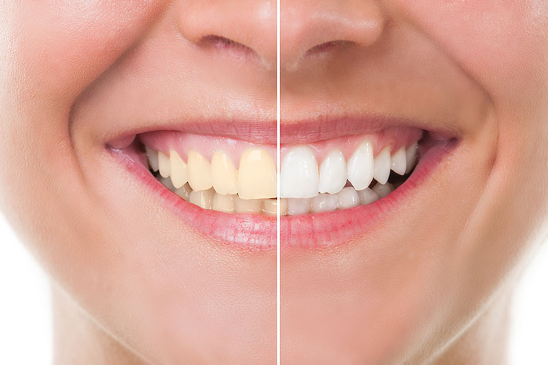 Teeth Whitening in Kent