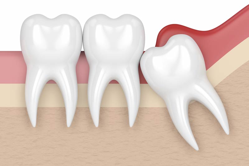 Wisdom Tooth Removal in Kent